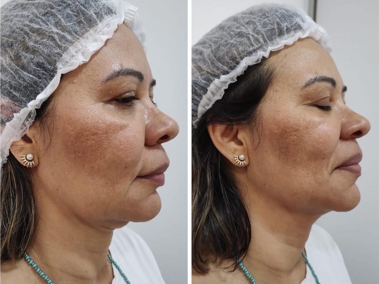 Antes e depois do ultrassom microfocado no rosto