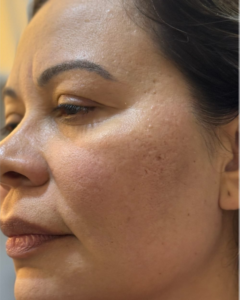 Resultado do ultrassom microfocado no rosto de uma cliente