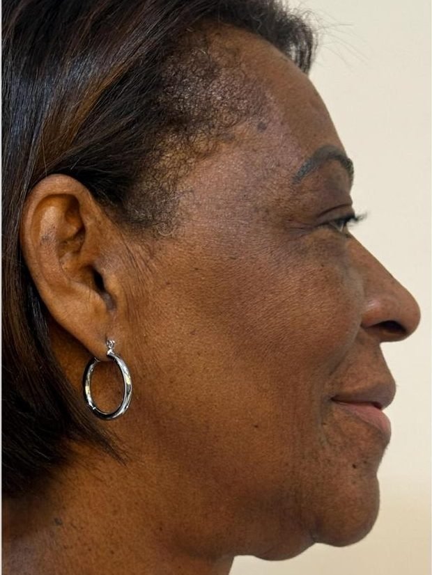 Contorno facial antes do ultrassom microfocado