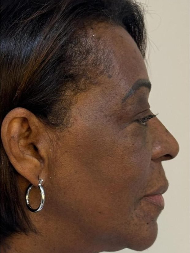 Contorno facial depois do ultrassom microfocado